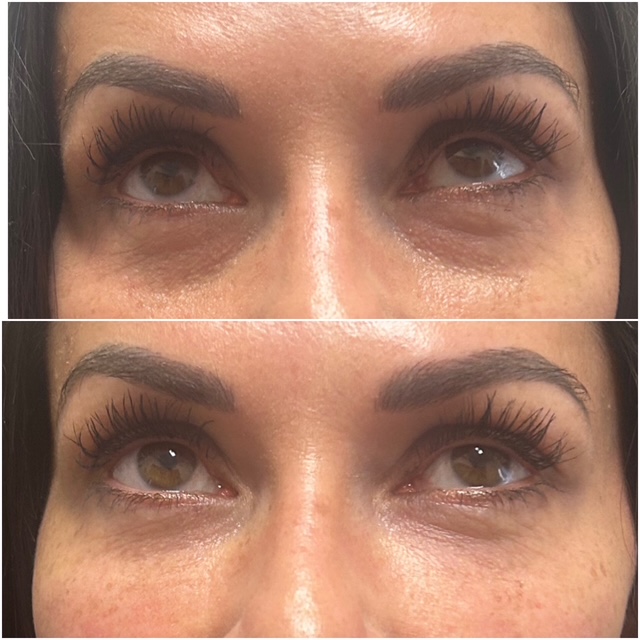 PRF EZ Gel treatment Sage Wellness & Aesthetics Urbana MD